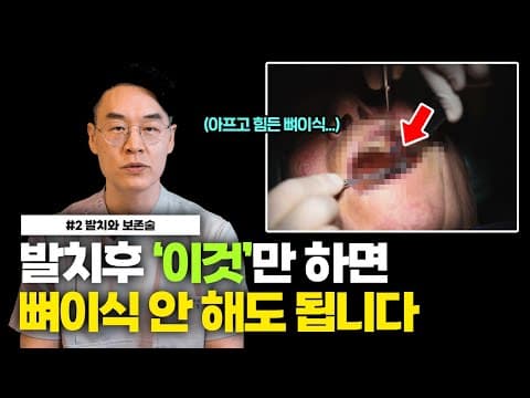 이렇게 하면 뼈이식 안 해도 됩니다. 임플란트 절대 미루지 마세요